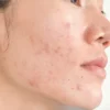 Lemon Face Gel For Oily Skin - Image 3